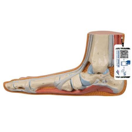 3B SCIENTIFIC Flat Foot (Pes Planus), w/ 3B Smart Anatomy 1000355